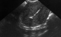 IUD sonogram